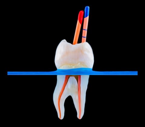 Granuloma dentale Trattamento Canalare